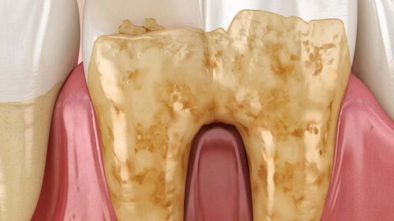 Зубной камень: 5 причин избавиться от него немедленно!