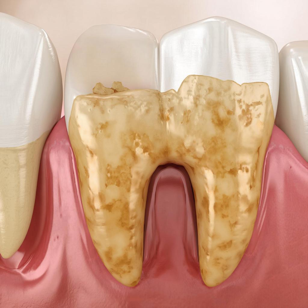 Зубной камень: 5 причин избавиться от него немедленно!