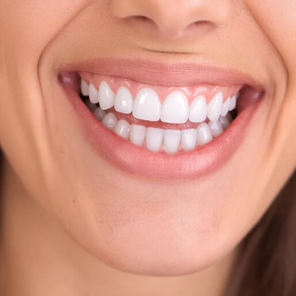 Эпоха Сияющих Улыбок: Путь к Совершенству с Винирами из Сверхпрочной Керамики